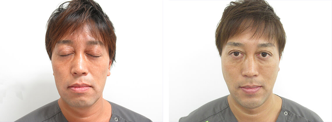 TAC式 ツヤ肌コラーゲンリフト®/顎のヒアルロン酸注射/エラボトックス注射の症例写真 施術前後 ２週間