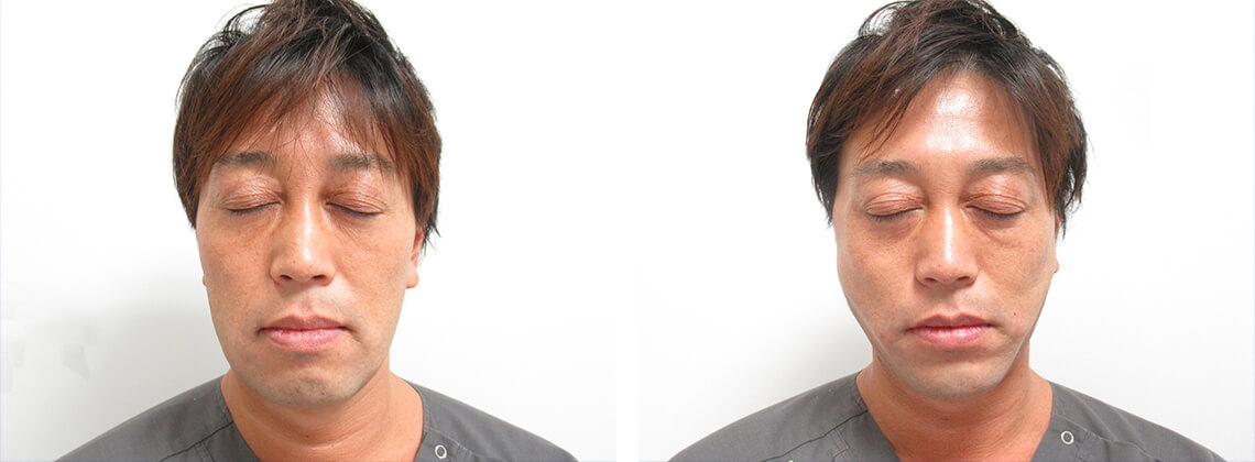 TAC式 ツヤ肌コラーゲンリフト®/顎のヒアルロン酸注射/エラボトックス注射の症例写真 施術前後 直後