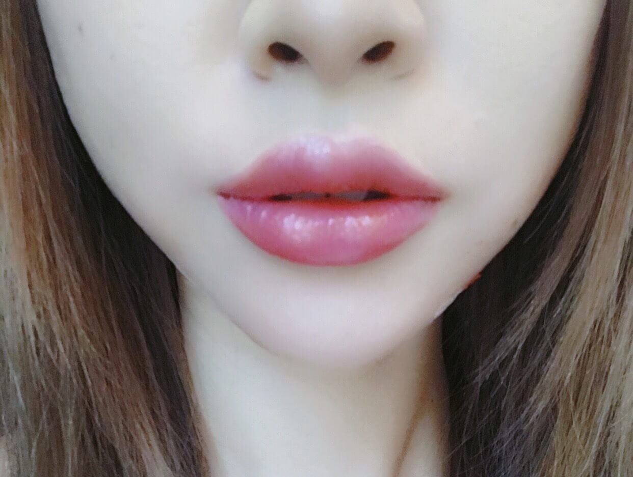 唇フィラーの症例です Taクリニック公式整形ブログ 画像 値段 美容整形 美容外科