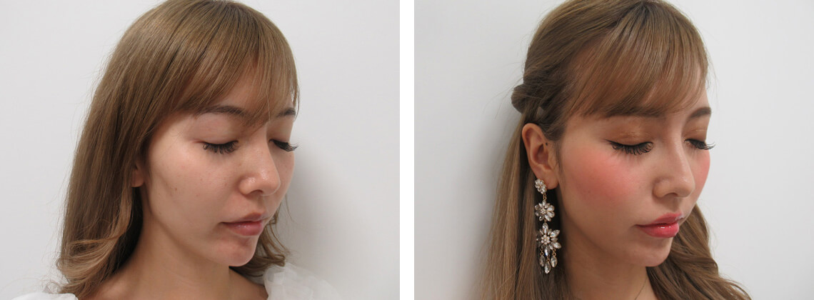 ウルトラセル（ハイフ）の症例写真 施術前後 直後