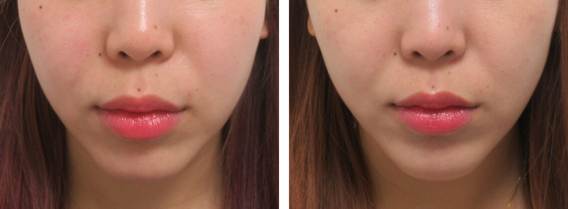 ナチュラルに引き上げます