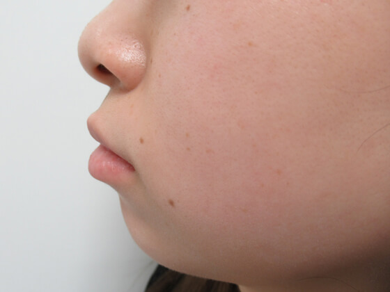 症例写真 ダウンタイム ヒアルロン酸で顎形成 Taクリニック 美容整形 美容外科