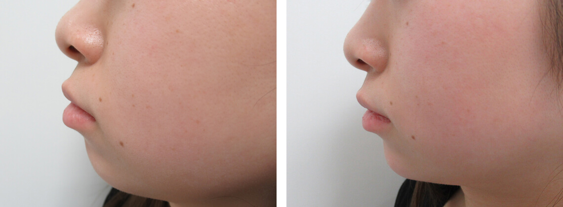 ヒアルロン酸で顎形成