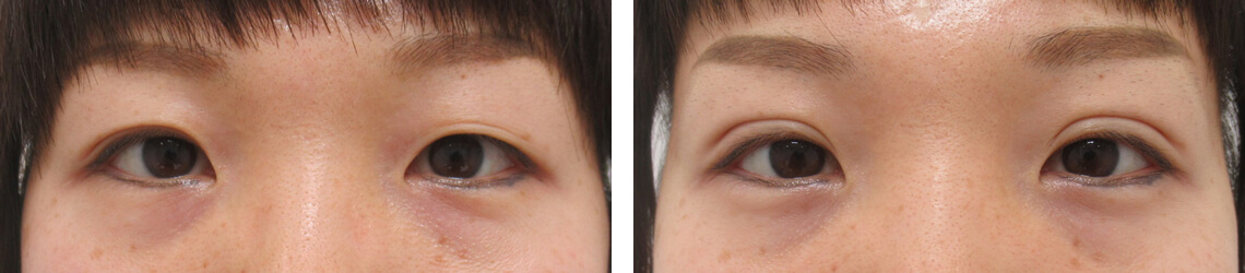 二重の左右差を調整