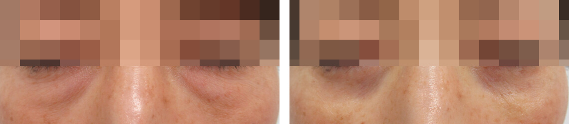 目の下のふくらみ取り直後