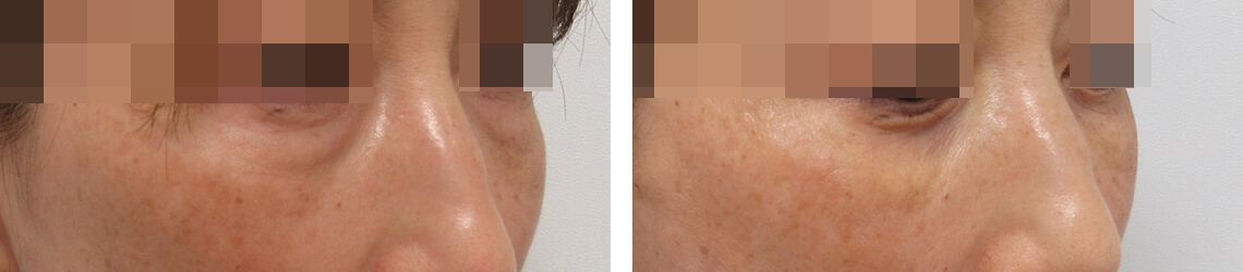 下眼瞼脱脂術（目の下のたるみ取り・目の下の脂肪ふくらみ取り）の症例写真 施術前後 直後