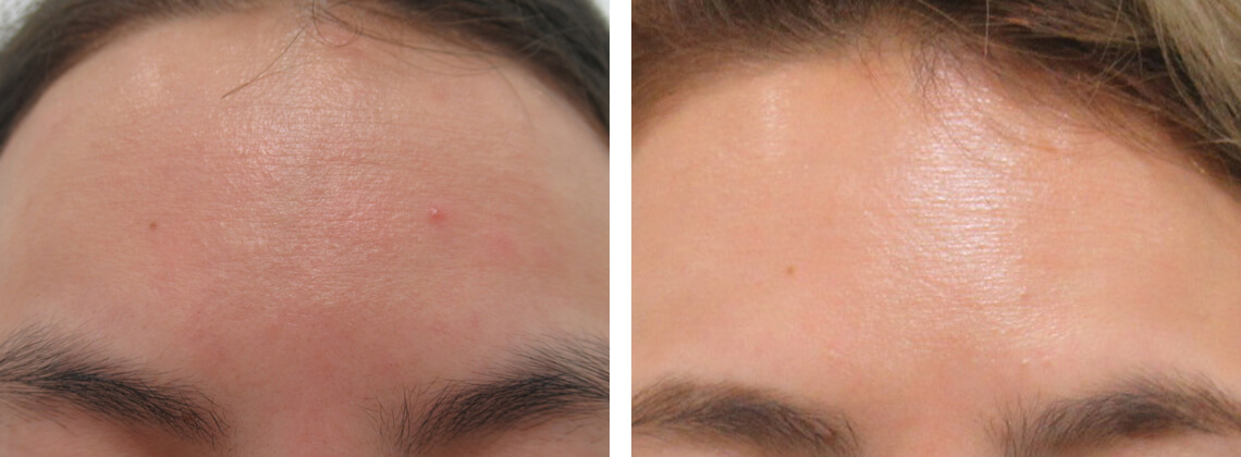 水光注射の症例写真 施術前後 １ヵ月