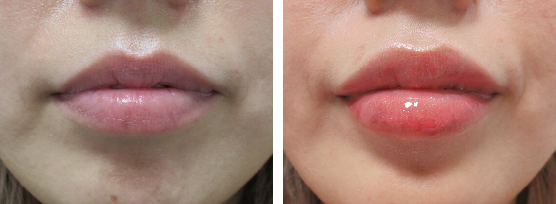 TAC式アヒル口形成