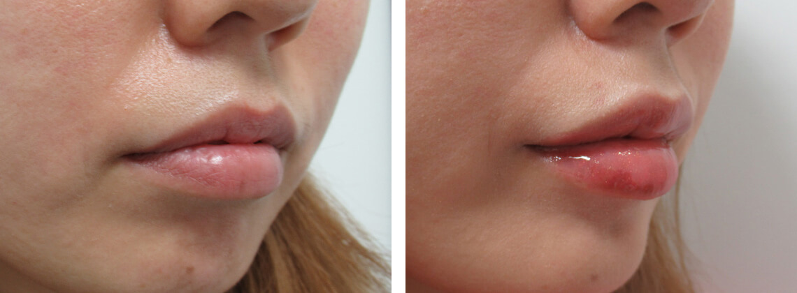 ラシャスリップス（医療機関専売）の症例写真 施術前後 １週間