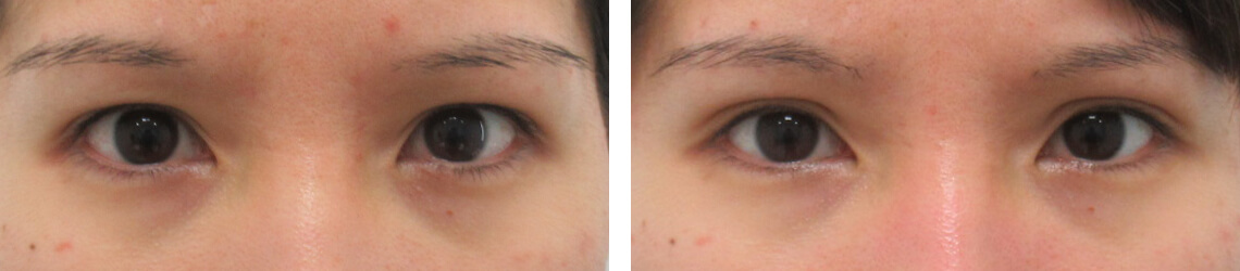 二重幅を広くして彫り深い目元に