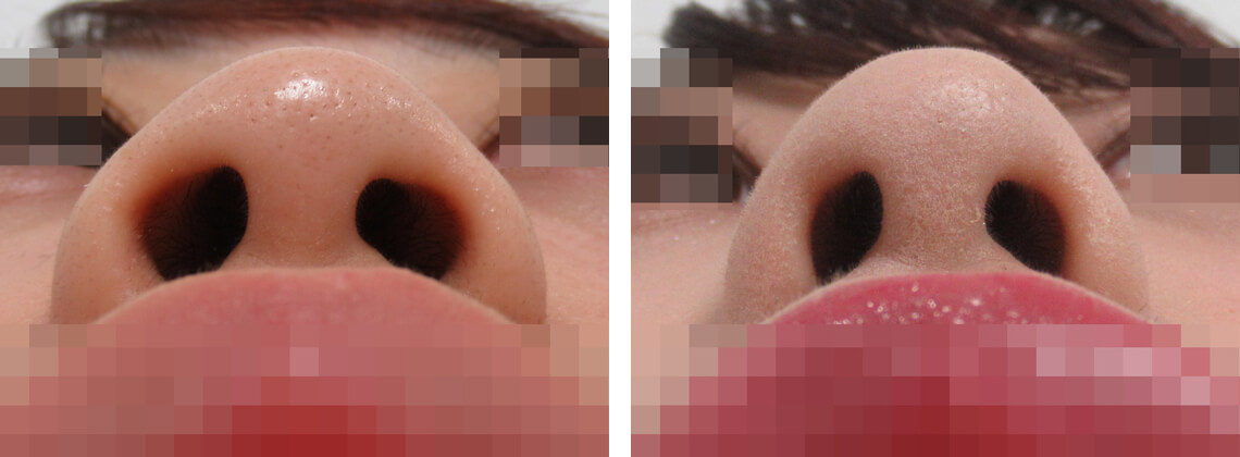 TAC式 鼻翼縮小術(小鼻縮小)/鼻のヒアルロン酸注射の症例写真 施術前後 1ヵ月