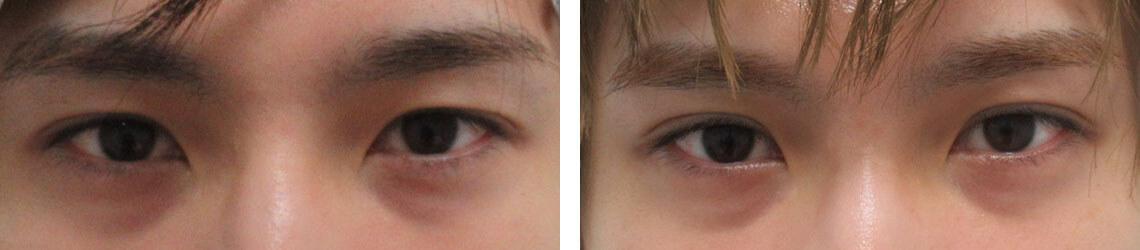 その方に似合う二重