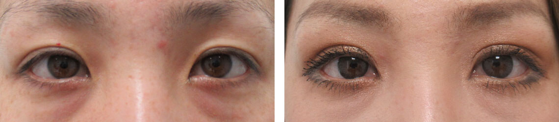 二重の幅を広げたい