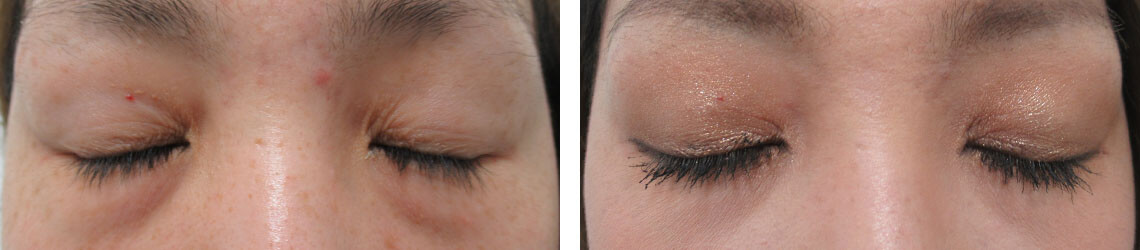 二重埋没法の症例写真 施術前後 １ヵ月