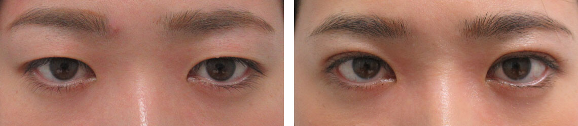 二重埋没法の症例写真 施術前後 １ヵ月