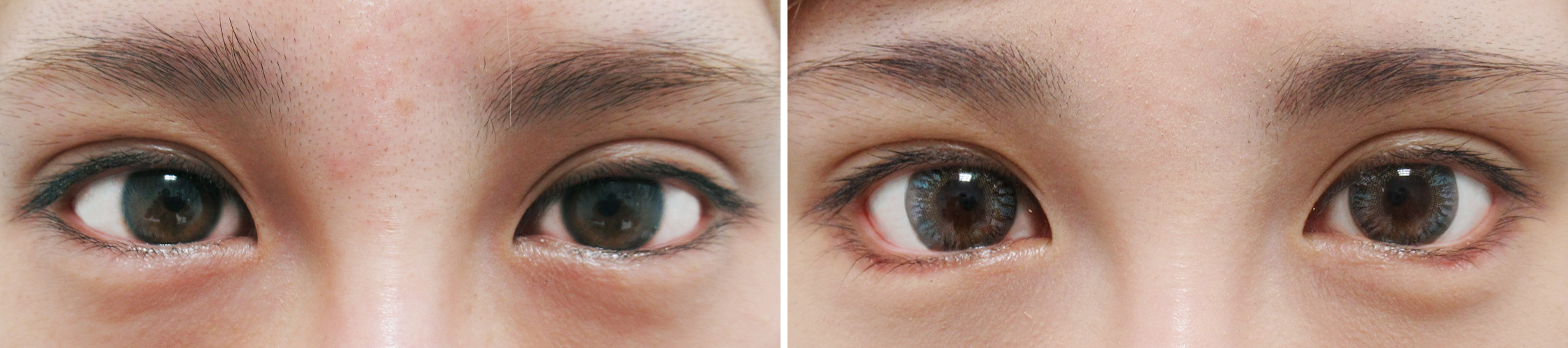 Suzu様グラマラスライン１ヶ月経過