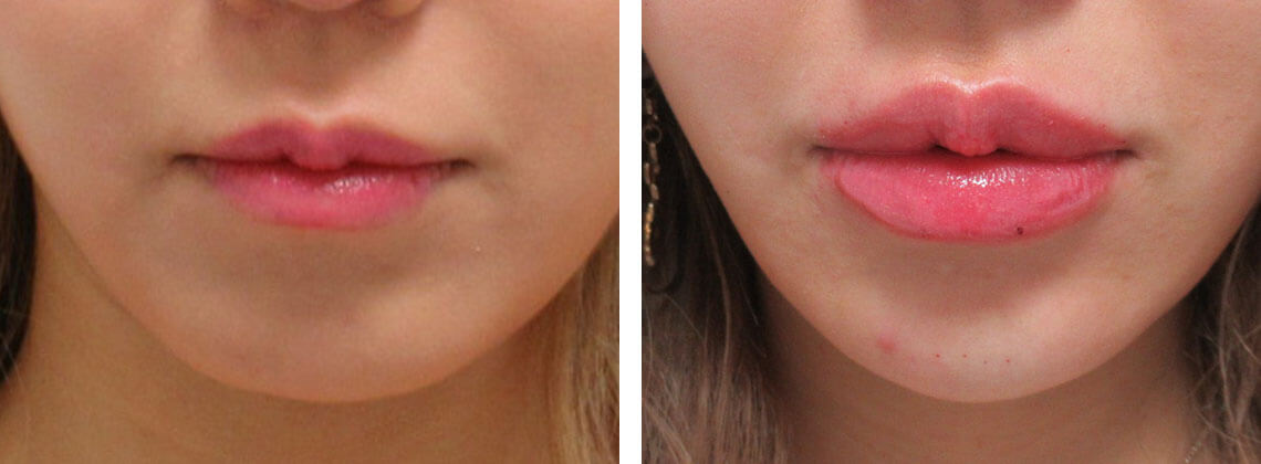 アヒル口と顎のバランス