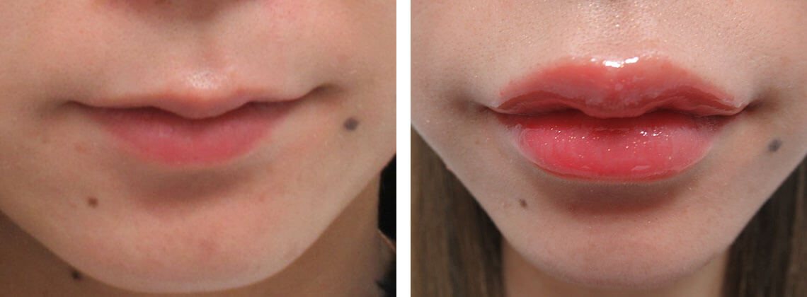 チャームポイントは残してアヒル口に