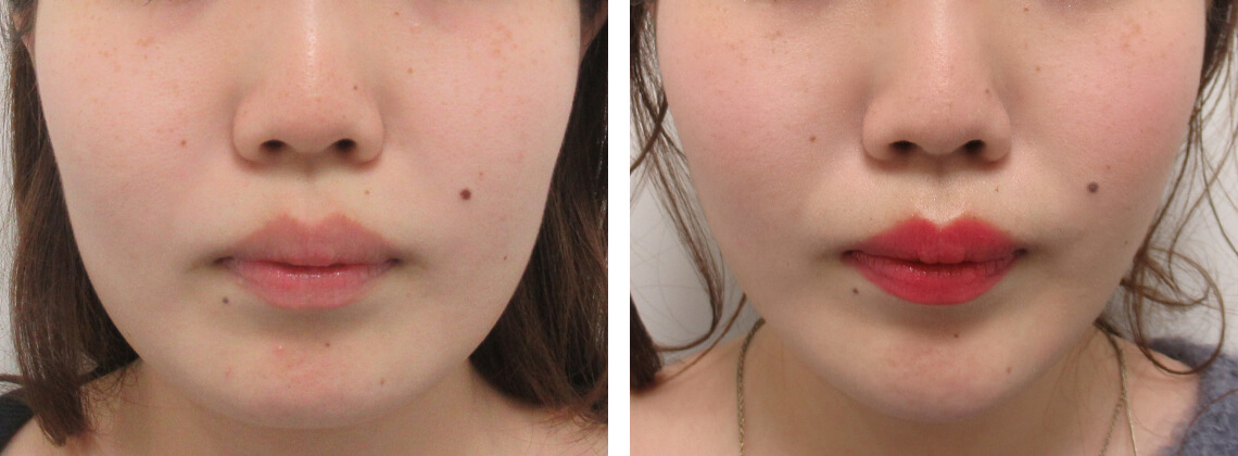 加工アプリを使わず小顔に