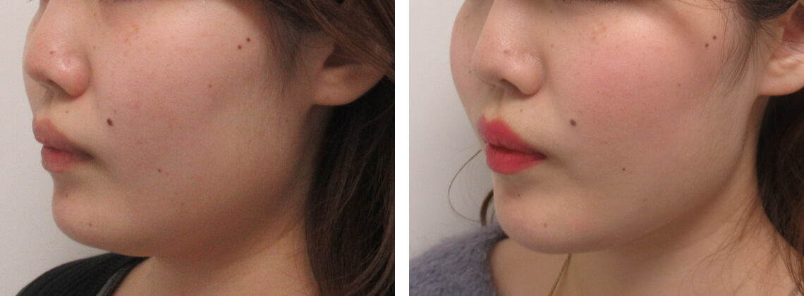 TAC式 ツヤ肌コラーゲンリフト®/ボトックス注射：その他/ヒアルロン酸注射：その他の症例写真 施術前後 １ヵ月