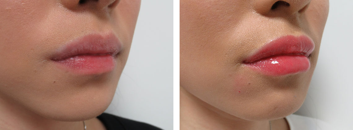 ヒアルロン酸注射：その他/ラシャスリップス（医療機関専売）の症例写真 施術前後 １週間