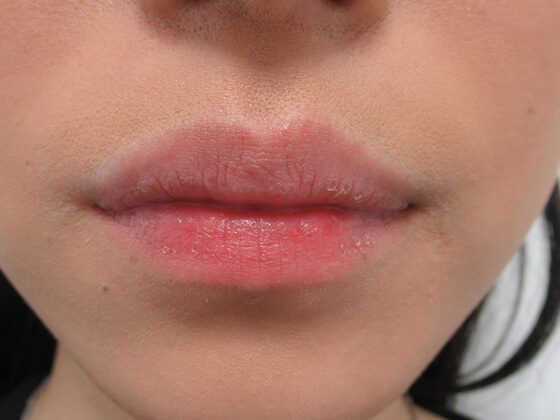 症例写真 ダウンタイム 唇の縦じわ改善 Taクリニック 美容整形 美容外科