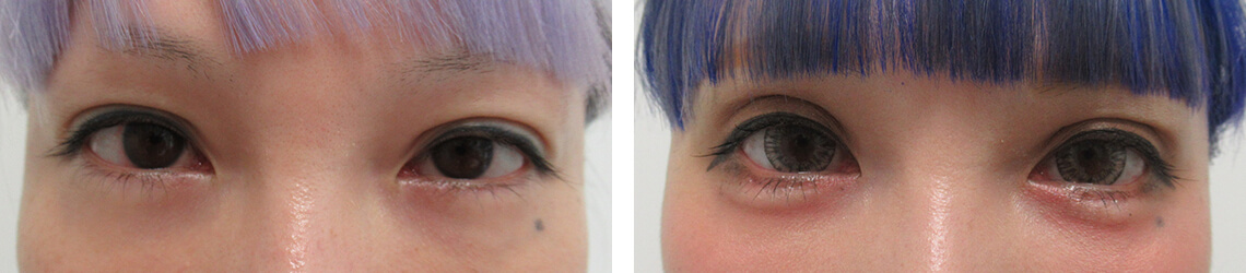 グラマラスライン（タレ目形成）/二重切開（全切開法）/ボトックス注射：その他の症例写真 施術前後 ２週間