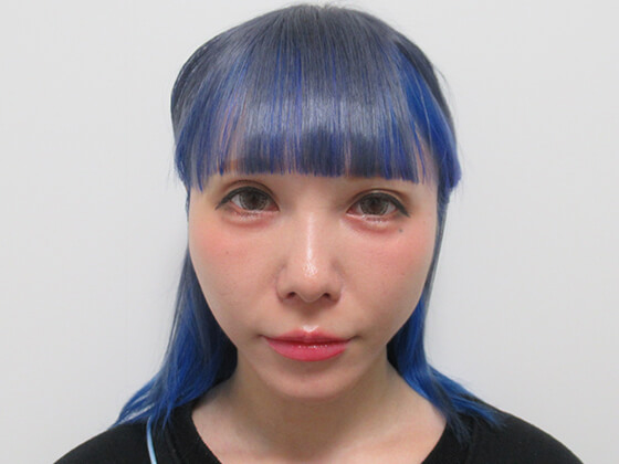 症例写真 ダウンタイム まいちゅん様リフトアップ２週間経過 Taクリニック 美容整形 美容外科