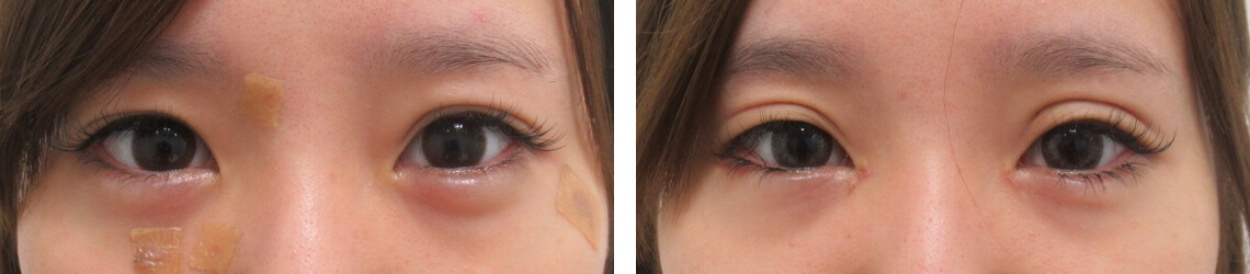 目頭切開術/二重切開（全切開法）/グラマラスライン（タレ目形成）の症例写真 施術前後 １ヵ月