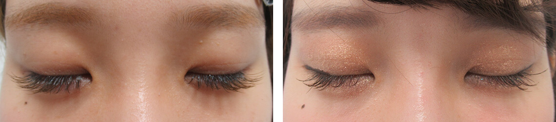 二重埋没法の症例写真 施術前後 １ヵ月