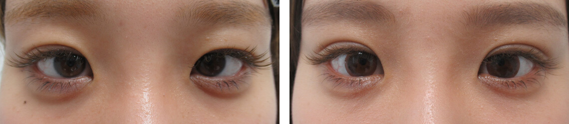 二重埋没法の症例写真 施術前後 ２週間