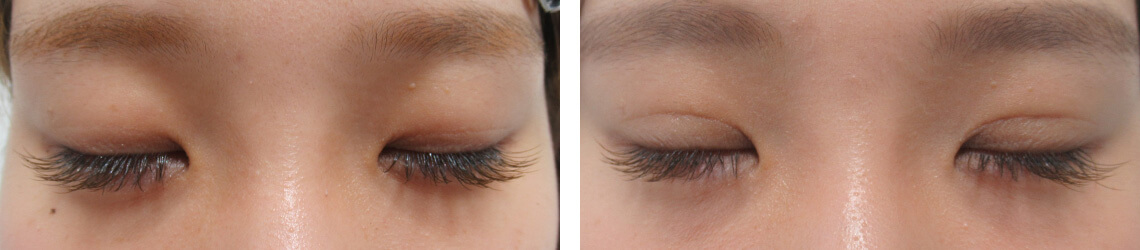 二重埋没法の症例写真 施術前後 ２週間