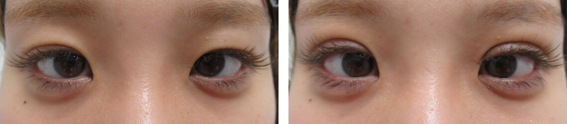 二重埋没法の症例写真 施術前後 直後