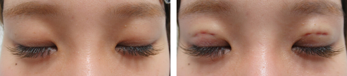 二重埋没法の症例写真 施術前後 直後