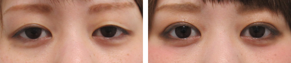 二重埋没法の症例写真 施術前後 １ヵ月