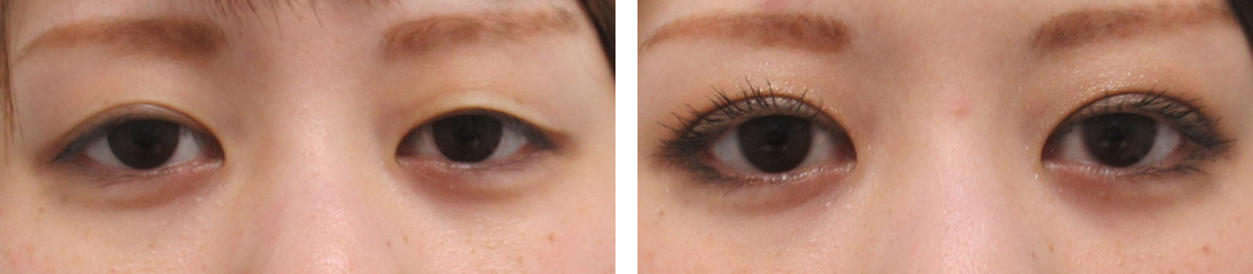 二重埋没法の症例写真 施術前後 １週間