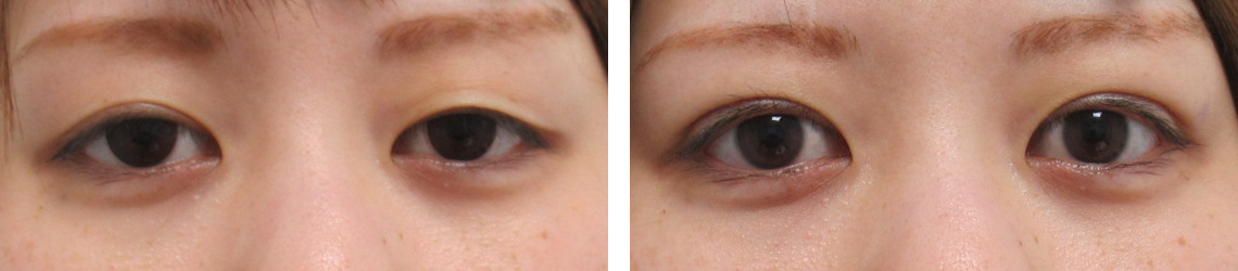 二重埋没法の症例写真 施術前後 直後