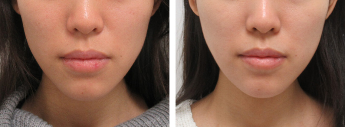 エラボトックスの組み合わせ