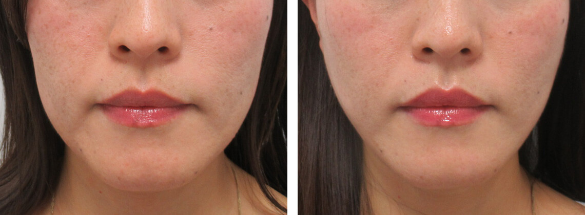 面長フェイスラインの方にも