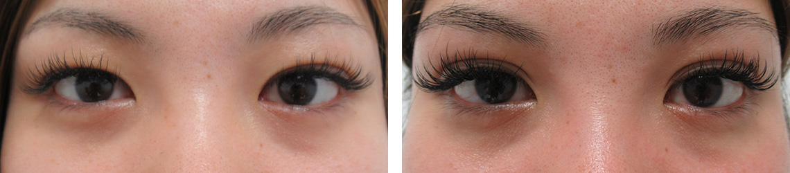 二重埋没法の症例写真 施術前後 ３ヵ月