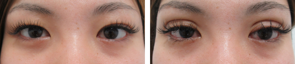 二重埋没法の症例写真 施術前後 直後