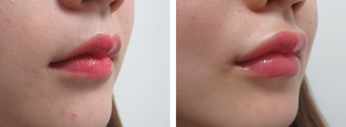 の症例写真 施術前後 １ヵ月