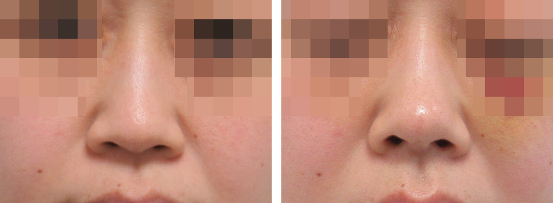 ヴィーナスノーズ（切らない鼻中隔延長術）の症例写真 施術前後 １週間