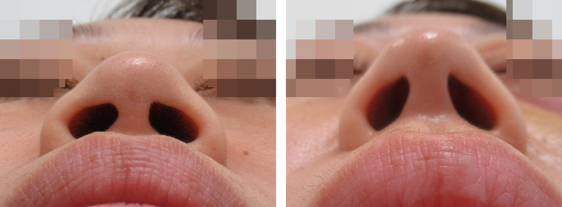 潰れた鼻先を整える