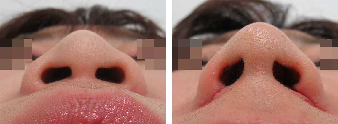 お鼻の横幅と高さを調整