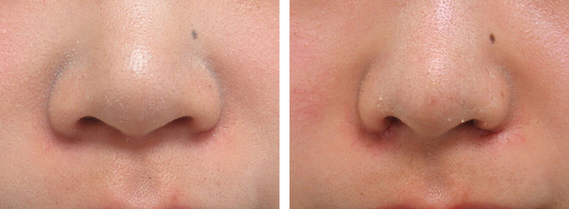 TAC式 鼻翼縮小術（小鼻縮小）/ヴィーナスノーズ（切らない鼻中隔延長術）/ヒアルロン酸注射：その他の症例写真 施術前後 １週間