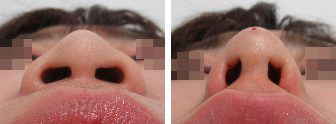 TAC式 鼻翼縮小術（小鼻縮小）/ヴィーナスノーズ（切らない鼻中隔延長術）/ヒアルロン酸注射：その他の症例写真 施術前後 直後
