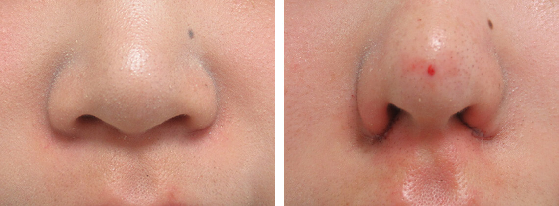 TAC式 鼻翼縮小術（小鼻縮小）/ヴィーナスノーズ（切らない鼻中隔延長術）/ヒアルロン酸注射：その他の症例写真 施術前後 直後