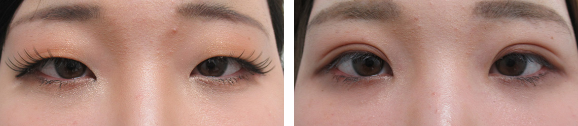 埋没と脱脂で二重まぶたに