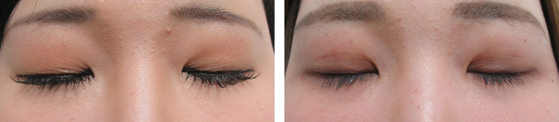 二重埋没法の症例写真 施術前後 １ヵ月